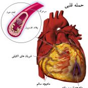 پروژه ی پزشکی در مورد سکته ی قلبی